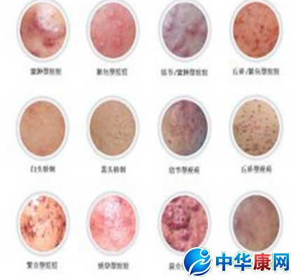 怎么样去痘