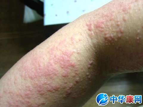 海鲜皮肤过敏症状