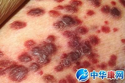 艾滋病皮疹图片