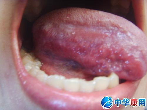 儿童口腔尖锐湿疣_舌头下长尖锐湿疣痛吗_图片搜索wwwwoyid