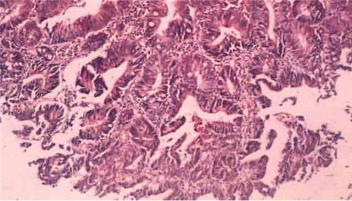 肠管状腺瘤(tubular+adenoma)_胃肠外科学